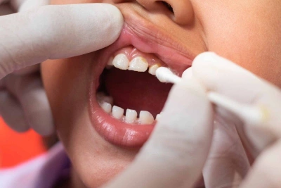 Fluoride of Silver Diamine (SDF) 